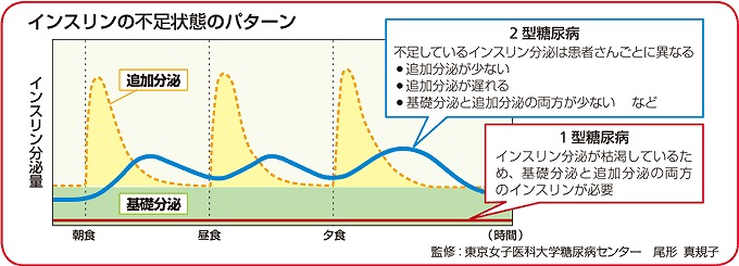 インスリン製剤の種類