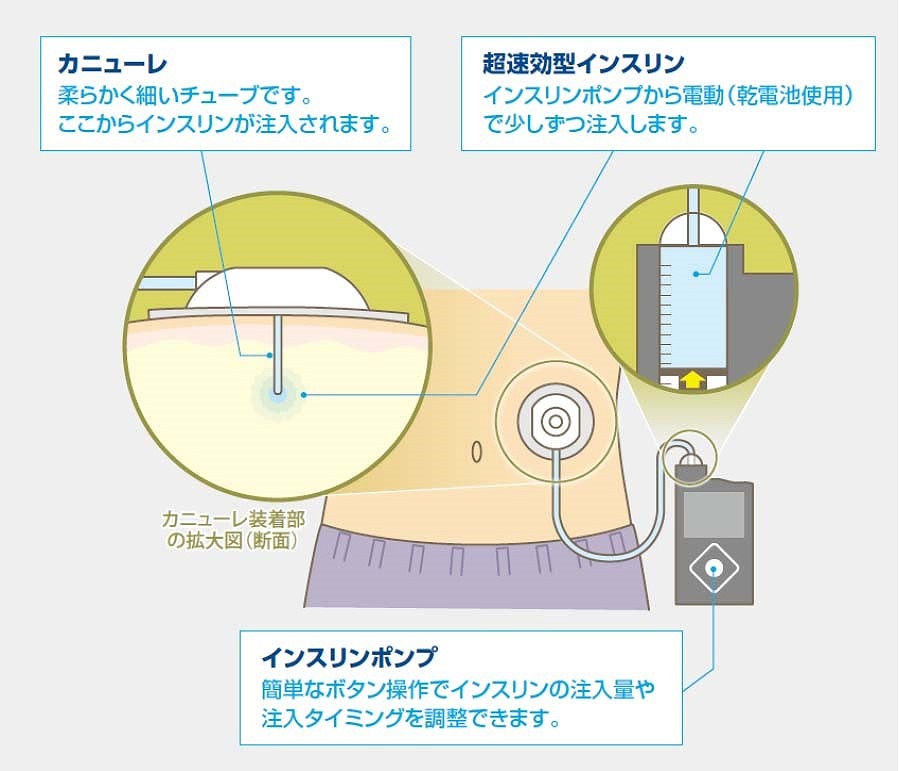 インスリンポンプ療法