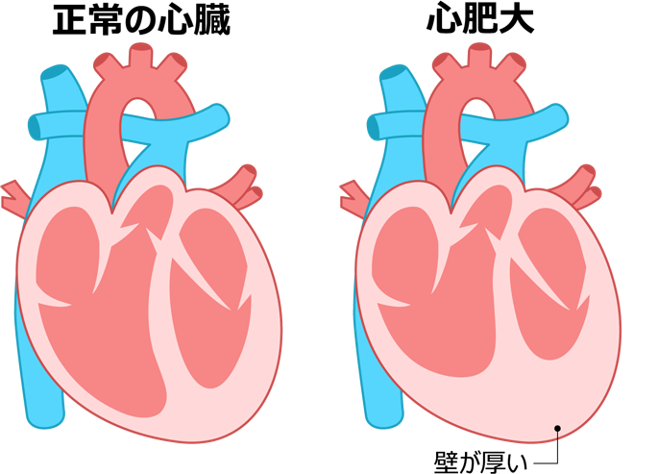心肥大イメージ