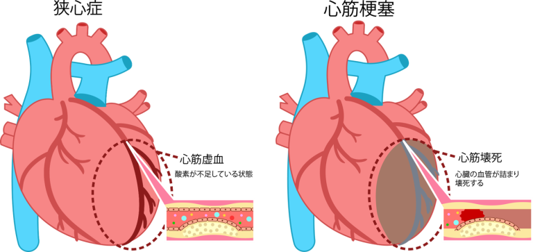 狭心症・心筋梗塞