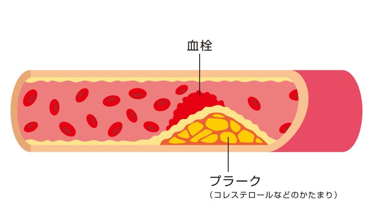 コレステロール