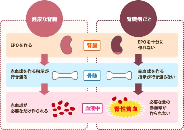 腎性貧血